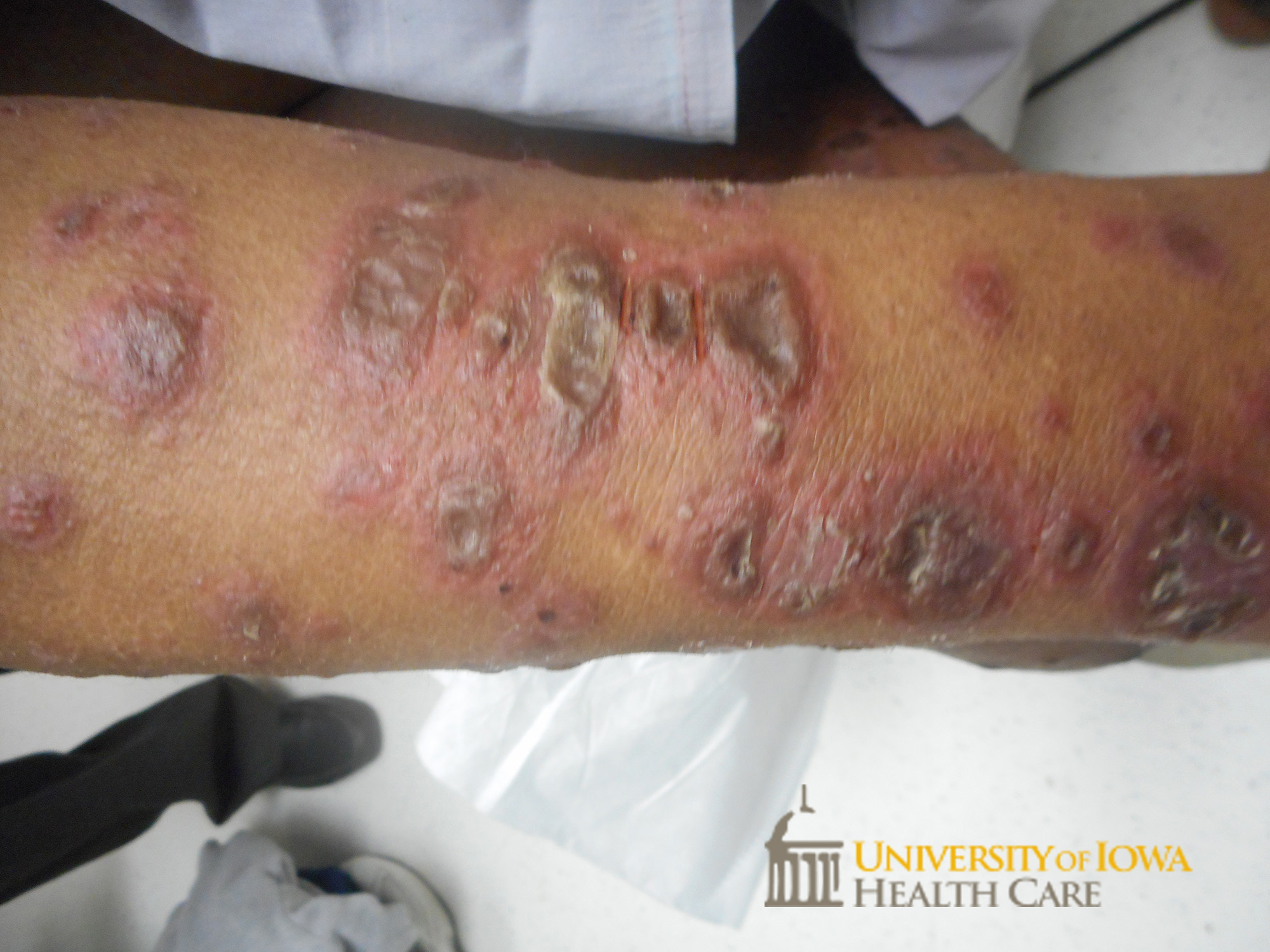 Pink papules and plaques, some with overlying brown scale, on the extremity. (click images for higher resolution).